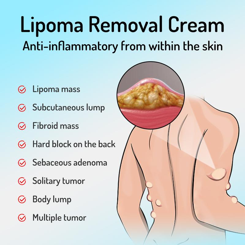 South Moon Lipoma Removal Cream, Relieve Fat Caking Tumor Subcutaneous Lumps Unclog Body Care