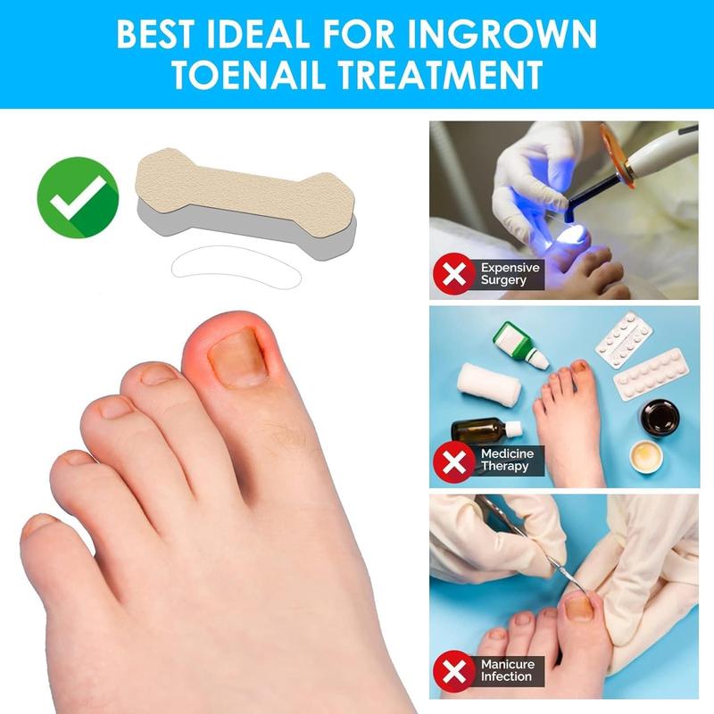 Breathable Ingrown Toenail Care Strip, 100pcs set Comfort Ingrown Toenail Sticker, Professional Pedicure for Ingrown Toenail