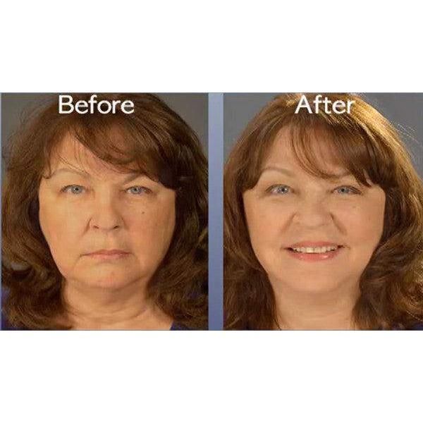 Art Harding Instant Face and Neck Lift - For A Firmer, Youthful Appearance - Available in Light and Dark - Kit includes 20 Tapes Kit Skincare