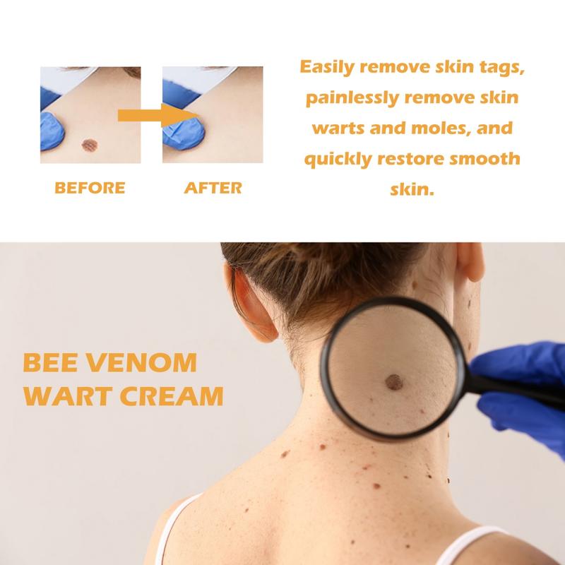 Bee Venom Wart Cream | Fast & Painless Wart Removal | Skin Smoother with Natural Ingredients Acne Skincare