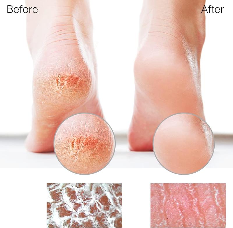 Glass Foot File Callus Remover for Feet, Heel Scraper, Pumice Stone, Diabetic Feet Scrubber Dead Skin Remover for Feet Professional Pedicure Tools