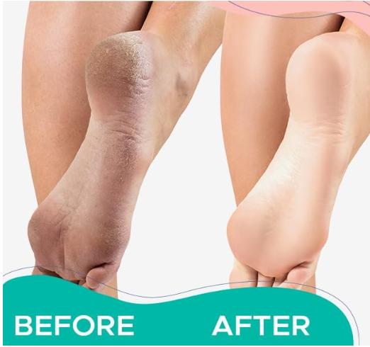 Professional B.est Callus Remover Gel for Feet and Foot Pumice Stone Scrubber Kit Remove Hard Skins Heels and Tough Callouses from feet Quickly and Effortless 4 oz (1 Bottle) Manicure Nail Nail Care Smooth